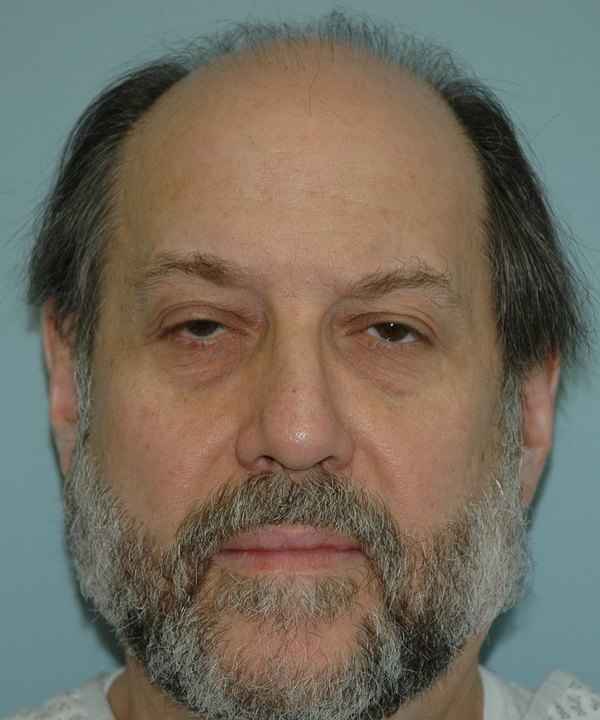 Before: frontal balding, front view
